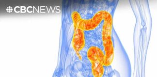 Why colon cancer is affecting people at a younger age