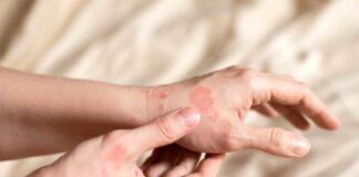 Close-up of a person's hands showing skin irritation and redness