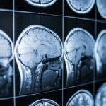 Close-up of MRI brain scans displayed on a screen