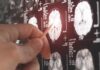 A hand pointing at a brain MRI scan on a screen