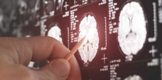 A hand pointing at a brain MRI scan on a screen