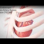 Totally Endoscopic Coronary Artery Bypass Procedure (TECAB)