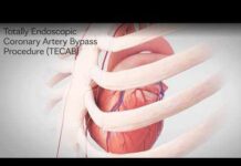 Totally Endoscopic Coronary Artery Bypass Procedure (TECAB)