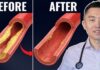 #1 Best Meal to UNCLOG Your Arteries (Backed by Science)