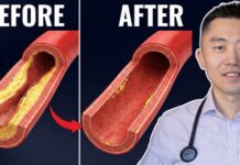 How to Clear Blocked Arteries without Surgery #1 Best Meal to UNCLOG Your Arteries (Backed by Science)