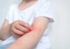 How Stress Leads To Allergies Child's arm showing skin irritation and redness