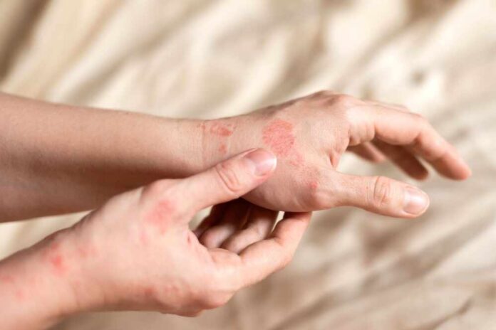 Itching,On,Hands,With,Redness,Rash.,Cause,Of,Itchy,Skin Close-up of a person's hands showing skin irritation and redness