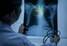 Marfan Syndrome: Tiny Bulge, Fatal Surprise? Doctor examining a chest X-ray with a stethoscope in hand