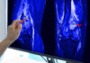 Sound Waves Rewire Arthritis—Doctors Stunned A hand pointing at an MRI scan of a knee joint on a monitor