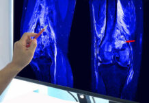 Sound Waves Rewire Arthritis—Doctors Stunned A hand pointing at an MRI scan of a knee joint on a monitor