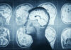 Hidden Protein Spike Hints Alzheimer’s Trouble Decades Early MRI scans of the brain displayed alongside a silhouette of a human head