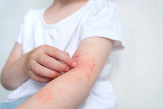 The,Child,Scratches,Atopic,Skin.,Dermatitis,,Diathesis,,Allergy,On,The Child's arm showing skin irritation and redness
