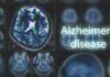 Brain MRI scans with highlighted section and text overlay
