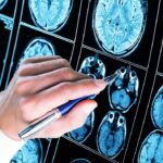 Hand with pen pointing at brain MRI scans
