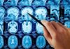 Brain Fog’s Dopamine Crash Stuns Scientists Hand pointing at brain MRI scans with a pen